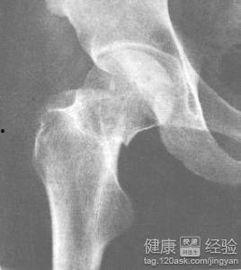 骨折痛苦视频,揭秘骨折康复之路